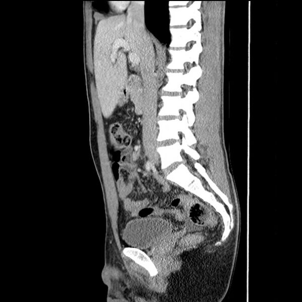 File:Acute appendicitis (Radiopaedia 27049-27227 Sagittal C+ portal venous phase 36).jpg