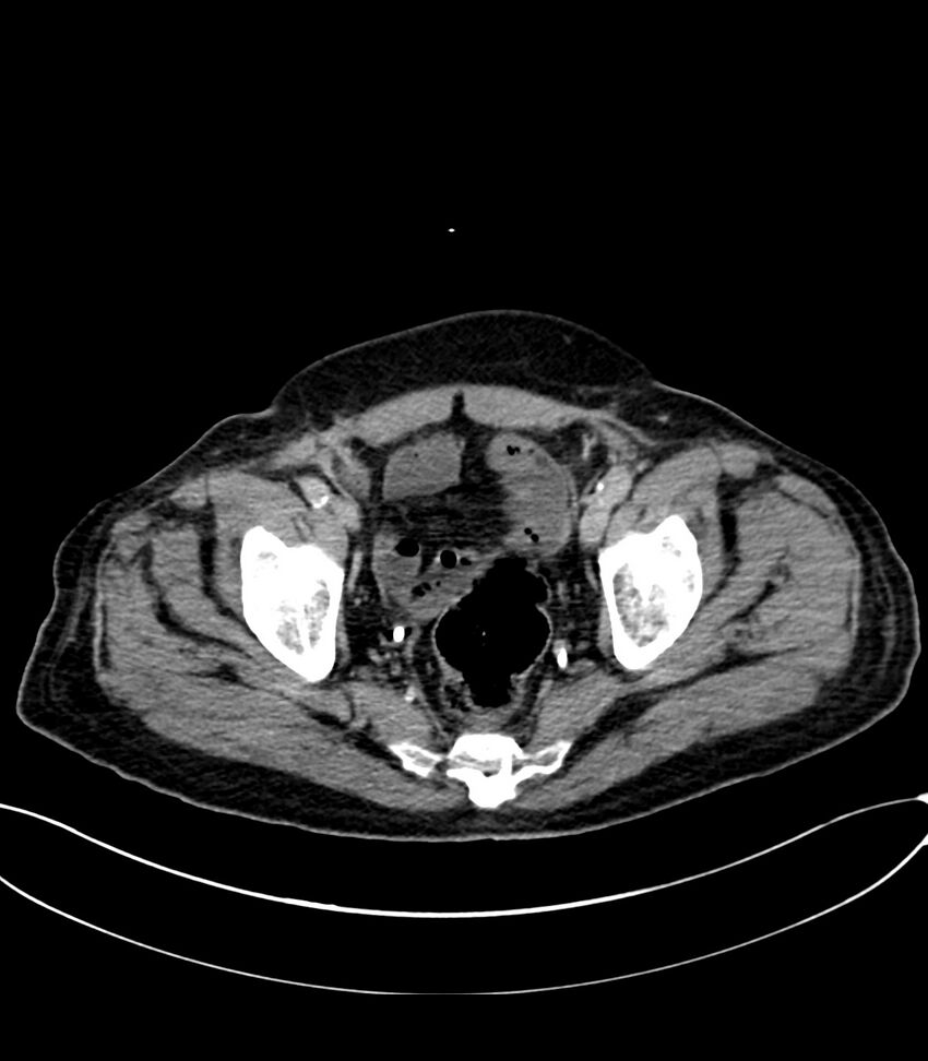 Acute arterial mesenteric ischemia (Radiopaedia 78238-90828 Axial C+ delayed 126).jpg