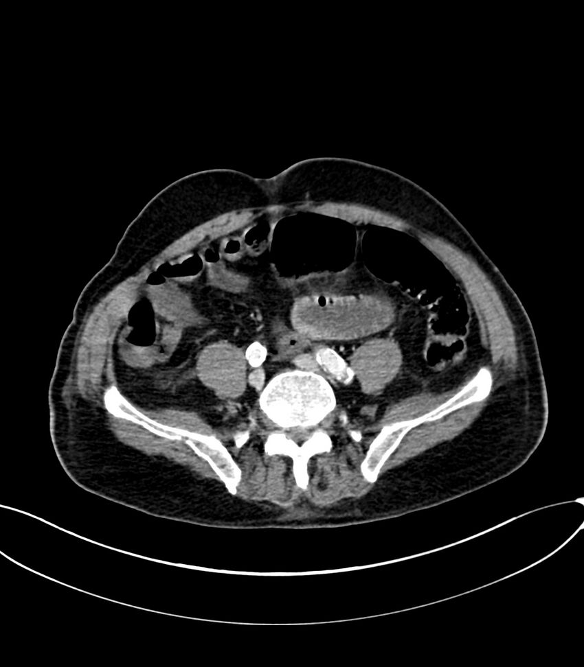 Acute arterial mesenteric ischemia (Radiopaedia 78238-90828 Axial C+ portal venous phase 98).jpg