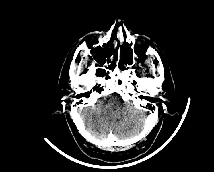File:Acute cerebral infarct (Radiopaedia 35604-37123 Axial non-contrast 17).jpg