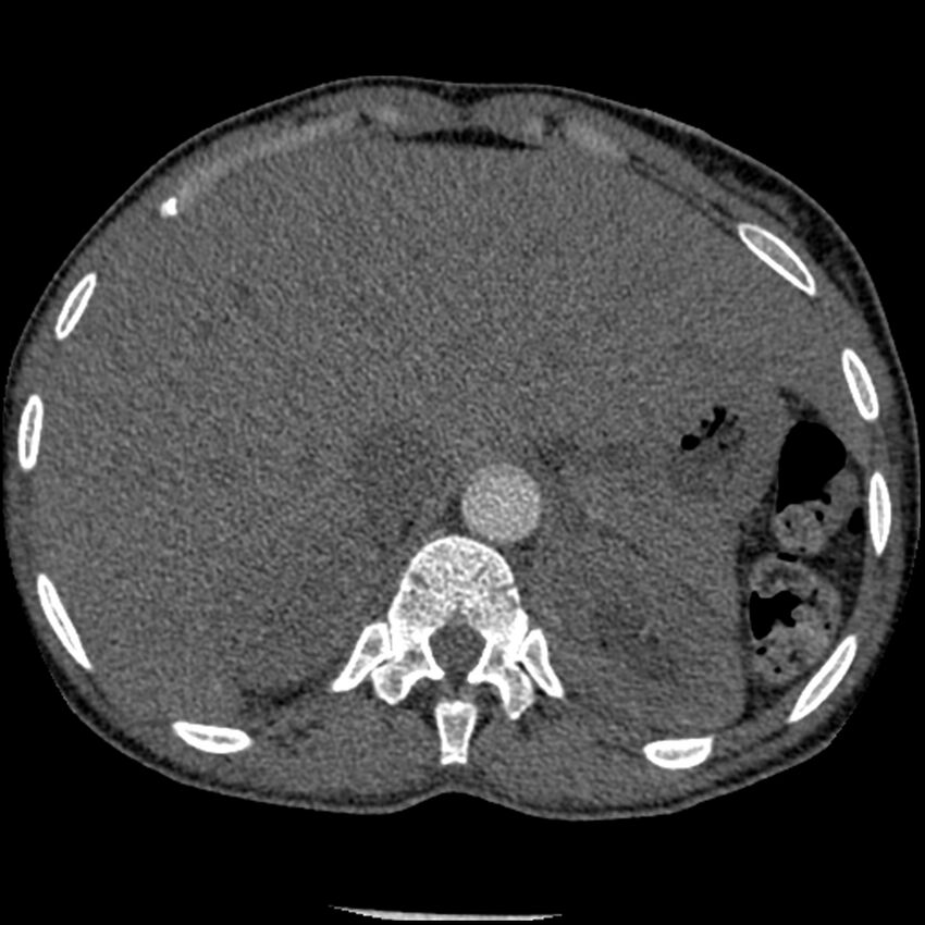 Acute chest syndrome - sickle cell disease (Radiopaedia 42375-45499 Axial C+ CTPA 186).jpg