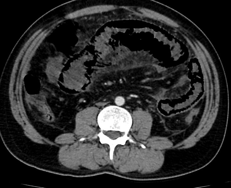 File:Acute mesenteric ischemia - superior mesenteric artery thrombosis (Radiopaedia 73947-84776 Axial C+ arterial phase 76).jpg