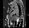 Acute myocarditis (Radiopaedia 40718-43366 Short axis LGE 10).PNG