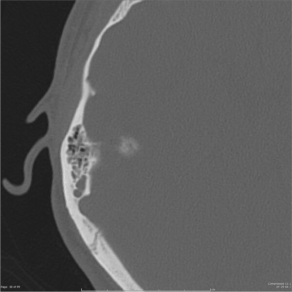 File:Acute otomastoiditis (Radiopaedia 28276-28512 Axial PTB bone window reformat 18).jpg