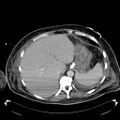 Acute pancreatic necrosis (Radiopaedia 13560-18503 Axial C+ portal venous phase 13).jpg