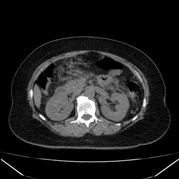 File:Acute pancreatitis - Balthazar C (Radiopaedia 26569-26714 Axial non-contrast 39).jpg