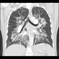 Acute pulmonary edema on CT (Radiopaedia 33582-34672 Coronal lung window 22).jpg