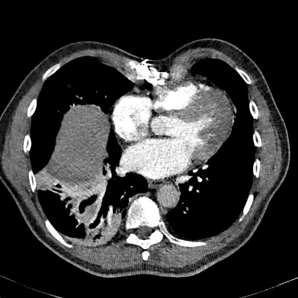 File:Acute pulmonary embolism (Radiopaedia 81677-95570 Axial C+ CTPA 76).jpg