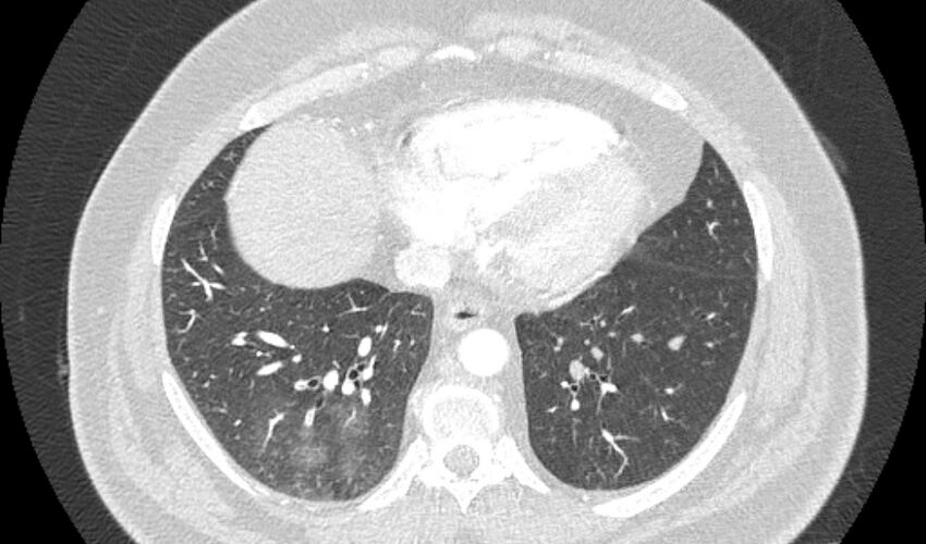 Acute pulmonary embolism with pulmonary infarcts (Radiopaedia 77688-89908 Axial lung window 92).jpg