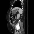 Acute pyelonephritis (Radiopaedia 25657-25837 Sagittal renal parenchymal phase 61).jpg