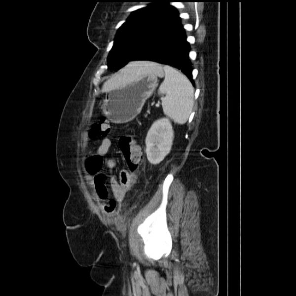 File:Acute pyelonephritis (Radiopaedia 25657-25837 Sagittal renal parenchymal phase 61).jpg