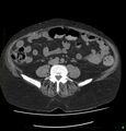 Acute renal failure post IV contrast injection- CT findings (Radiopaedia 47815-52557 Axial non-contrast 51).jpg