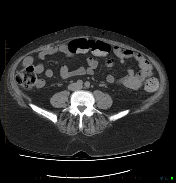 File:Acute renal failure post IV contrast injection- CT findings (Radiopaedia 47815-52557 Axial non-contrast 51).jpg