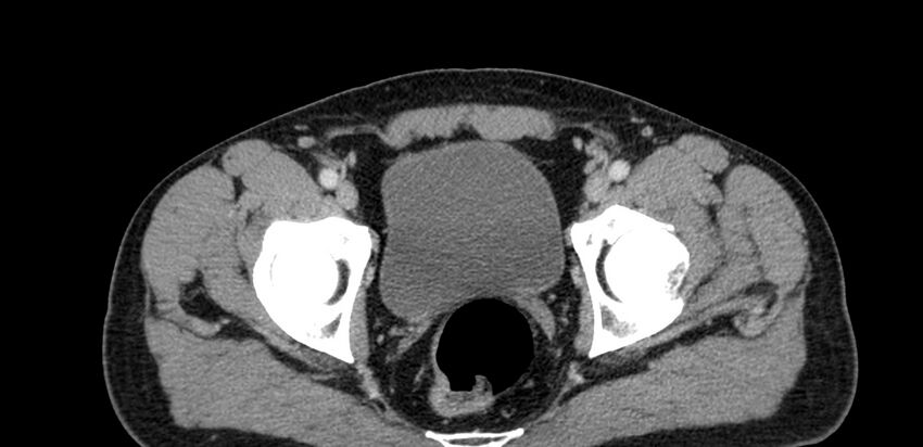 Acute sigmoid colon diverticulitis (Radiopaedia 55507-61976 Axial C+ portal venous phase 114).jpg