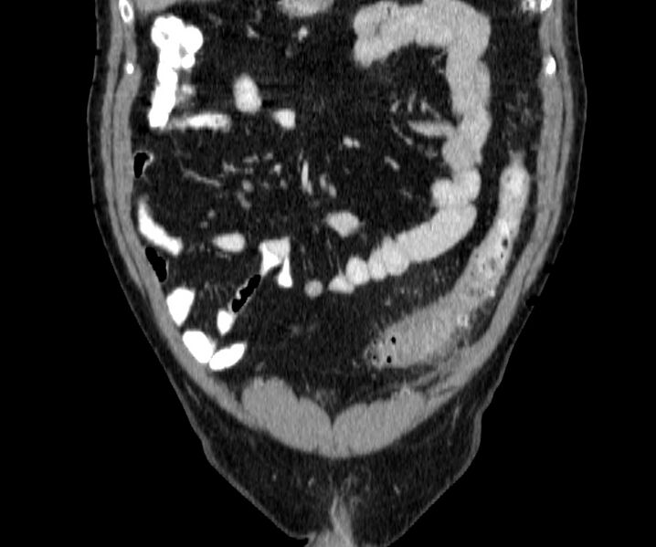 File:Acute sigmoid colon diverticulitis (Radiopaedia 55507-61976 Coronal C+ portal venous phase 29).jpg