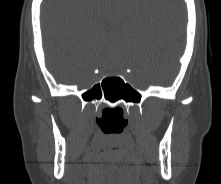 File:Acute sinusitis (Radiopaedia 22419-22455 Coronal bone window 32).jpg
