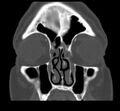 Acute sinusitis (Radiopaedia 23161-23215 Coronal bone window 26).jpg