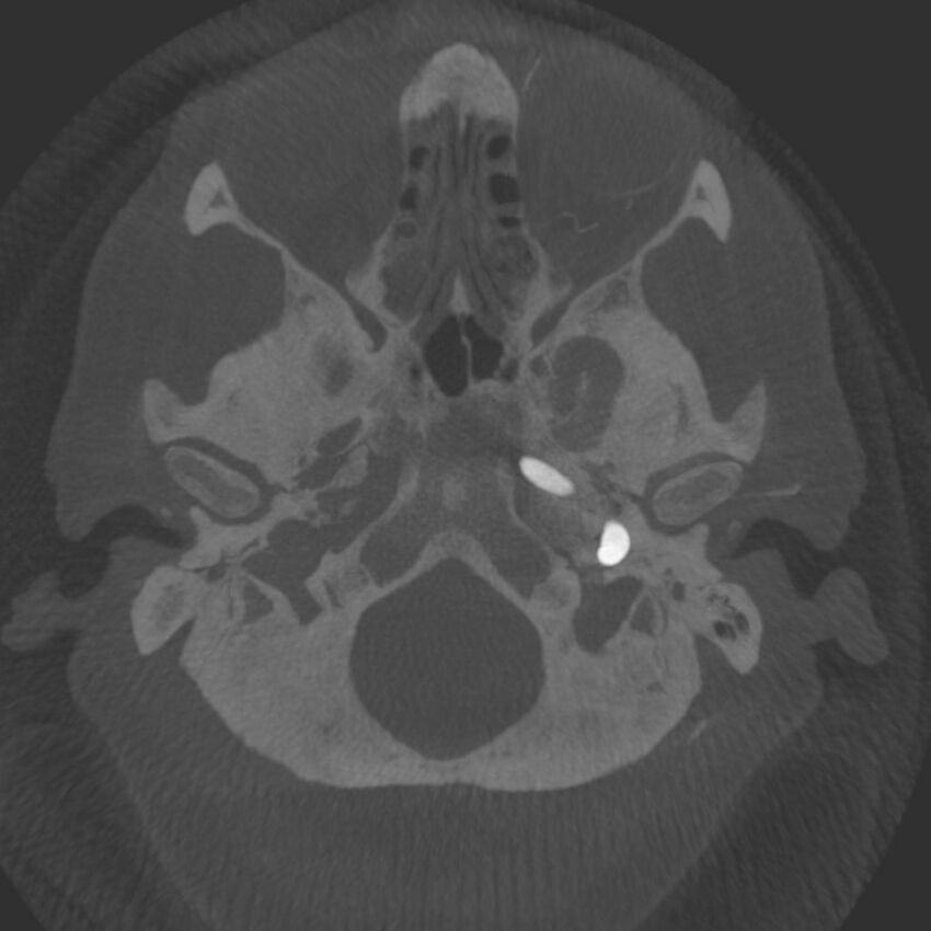 Acute subarachnoid hemorrhage and accessory anterior cerebral artery (Radiopaedia 69231-79010 C 6).jpg