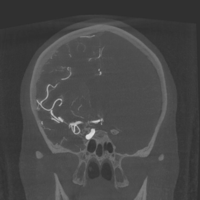 Acute subarachnoid hemorrhage and accessory anterior cerebral artery (Radiopaedia 69231-79010 Coronal arterial - MIP 41).jpg