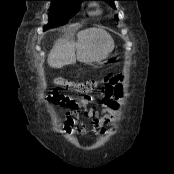 File:Acute tubular necrosis (Radiopaedia 28077-28334 D 20).jpg