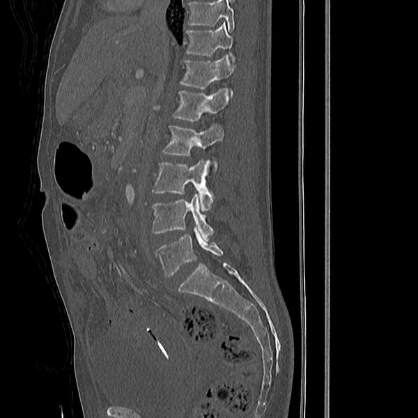 File:Acute vertebral body compression fractures (Radiopaedia 31757-32693 Sagittal bone window 32).jpg