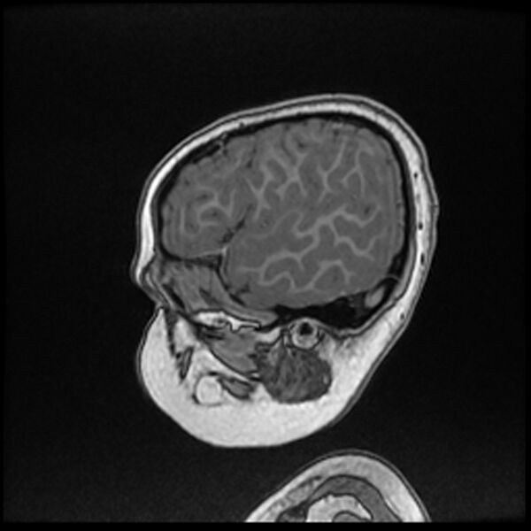 File:Adamantinomatous craniopharyngioma (Radiopaedia 77407-89529 Sagittal T1 C+ 19).jpg