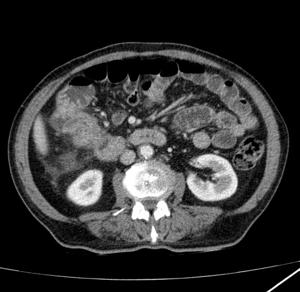 File:Adenocarcinoma of colon with entero-colic fistula (Radiopaedia 22832-22852 Axial C+ portal venous phase 37).jpg
