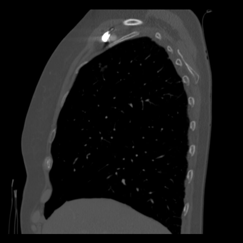 Adenocarcinoma of the lung (Radiopaedia 41015-43755 Sagittal bone window 22).jpg