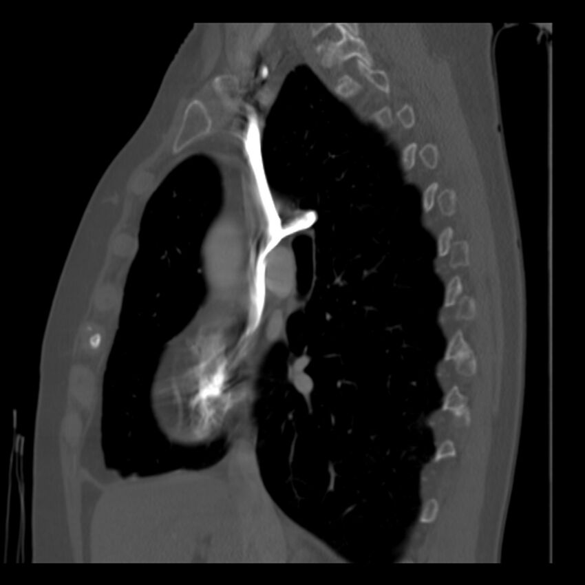 Adenocarcinoma of the lung (Radiopaedia 41015-43755 Sagittal bone window 44).jpg