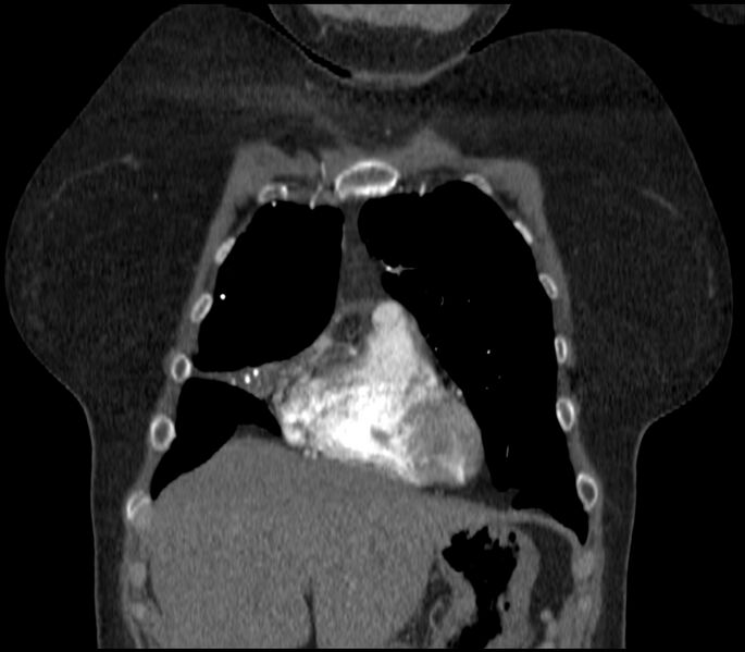 File:Adenocarcinoma of the lung (Radiopaedia 44205-47803 Coronal C+ portal venous phase 18).jpg
