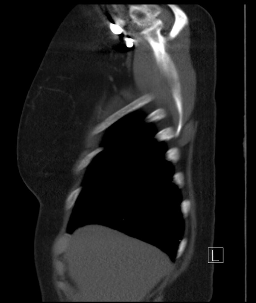 Adenocarcinoma of the lung (Radiopaedia 44205-47803 Sagittal C+ portal venous phase 50).jpg