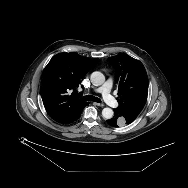 File:Adenocarcinoma of the lung (Radiopaedia 44876-48759 Axial C+ portal venous phase 36).jpg