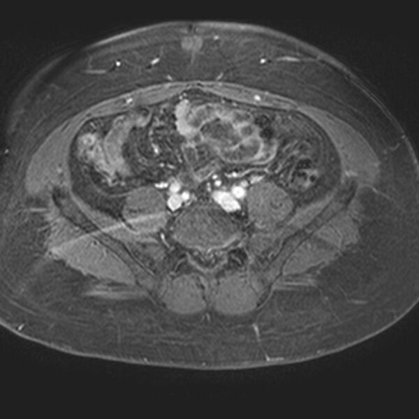 File:Adenomyoma of the uterus (Radiopaedia 9871-10439 Axial T1 C+ fat sat 23).jpg