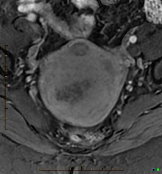 File:Adenomyosis uterus with hematometra (Radiopaedia 45779-50011 Axial T1 C+ fat sat 18).jpg