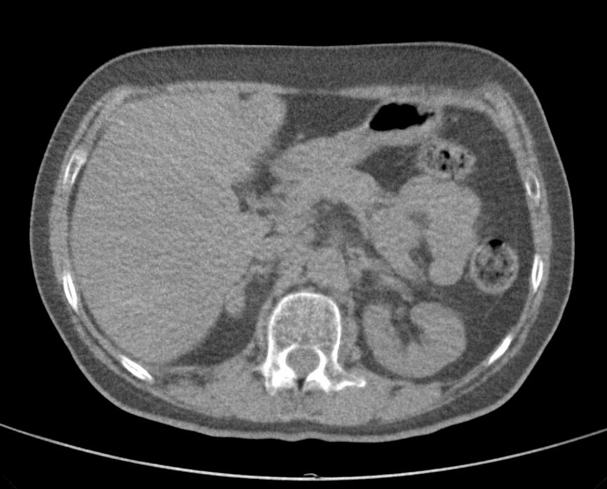 Adenosquamous lung carcinoma (Radiopaedia 22035-22030 non-contrast 63).jpg