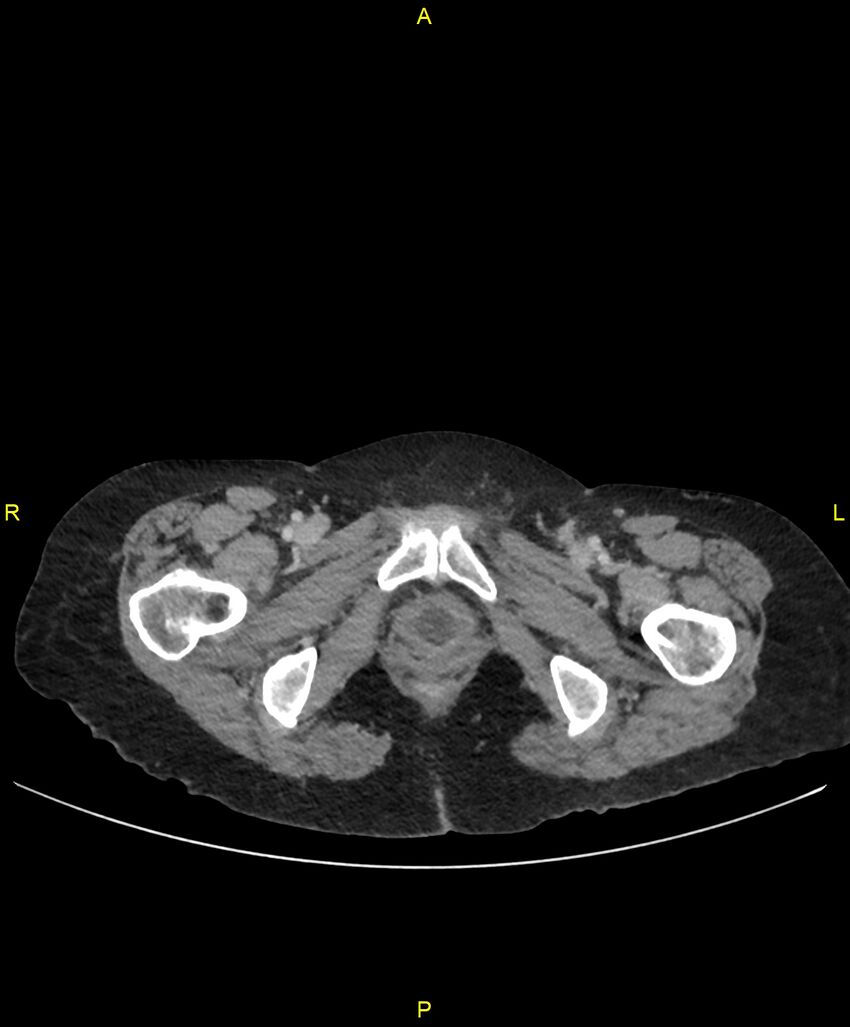 Adhesional small bowel obstruction (Radiopaedia 85402-101024 Axial C+ portal venous phase 296).jpg