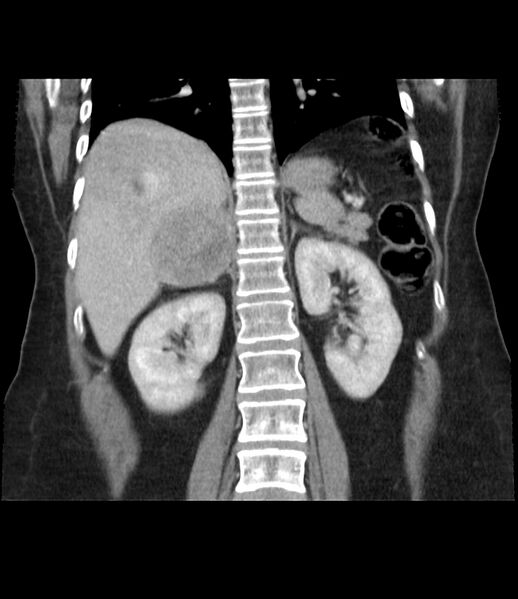 File:Adrenal cortical carcinoma with IVC invasion and thrombosis (Radiopaedia 34307-35597 Coronal C+ portal venous phase 33).jpg