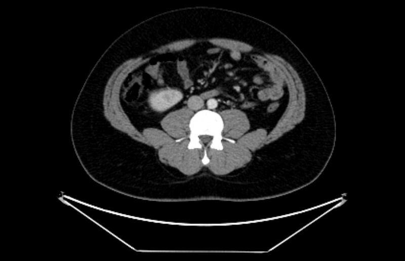 File:Adrenocortical carcinoma (Radiopaedia 80134-93438 Axial C+ portal venous phase 75).jpg