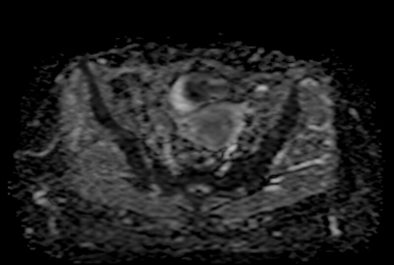 File:Adult granulosa cell tumor of the ovary (Radiopaedia 71581-81950 Axial ADC 12).jpg