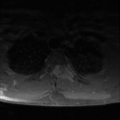 Aggressive vertebral hemangioma (Radiopaedia 39937-42404 Axial T1 C+ fat sat 34).png