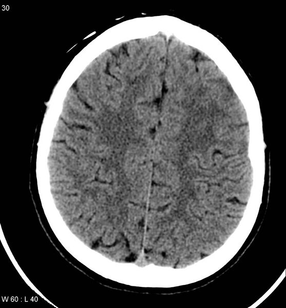 File:Aicardi syndrome (Radiopaedia 5353-7116 Axial non-contrast 27).jpg