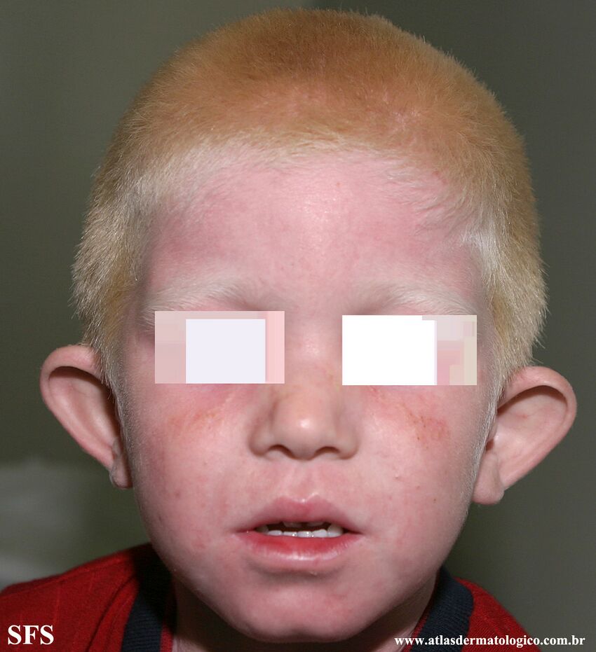 Albinism (Dermatology Atlas 5).jpg