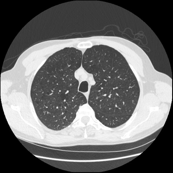 File:Alpha-1-antitrypsin deficiency (Radiopaedia 40993-43722 Axial lung window 51).jpg