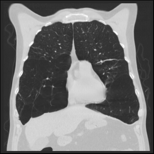 File:Alpha-1-antitrypsin deficiency (Radiopaedia 40993-43722 Coronal lung window 28).jpg