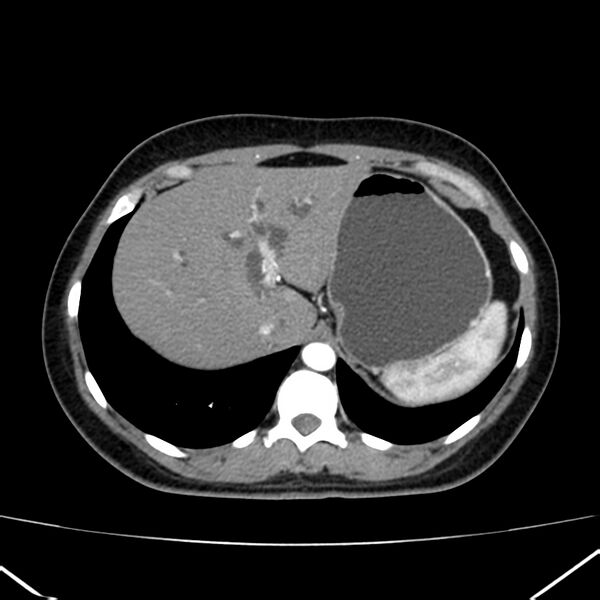 File:Ampullary tumor (Radiopaedia 22787-22816 B 17).jpg