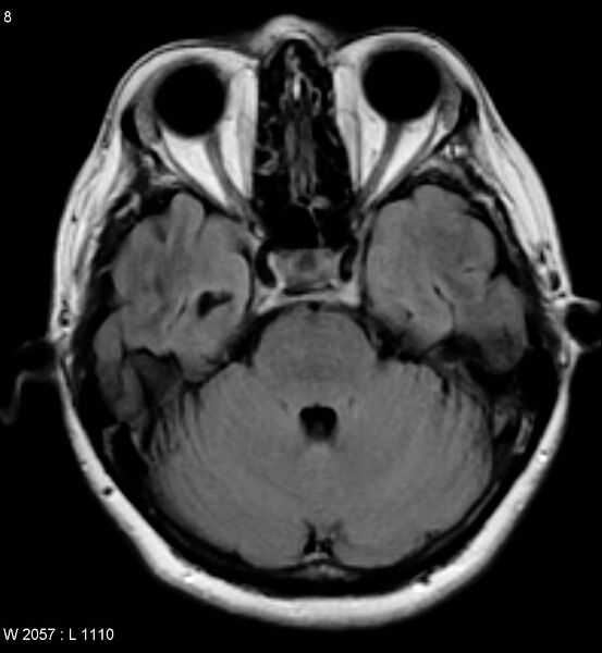 File:Amyotrophic lateral sclerosis (Radiopaedia 5373-7134 Axial FLAIR 8).jpg