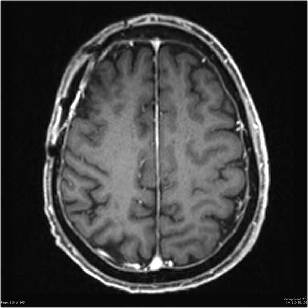 File:Anaplastic meningioma with recurrence (Radiopaedia 34452-35788 Axial T1 C+ 110).jpg
