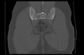 Aneurysmal bone cyst of ischium (Radiopaedia 25957-26094 Coronal bone window 38).png