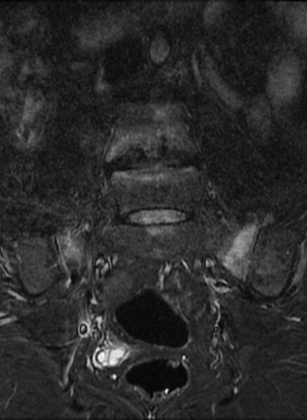 File:Ankylosing spondylitis - Andersson lesion (Radiopaedia 81878-95838 Coronal STIR 5).jpg