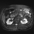 Annular pancreas (Radiopaedia 38292-40320 Axial T2 fat sat 16).png